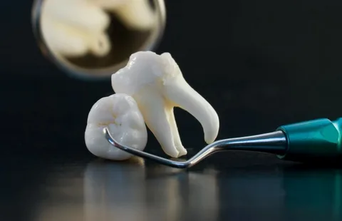 dental-extractions-kitchener-waterloo