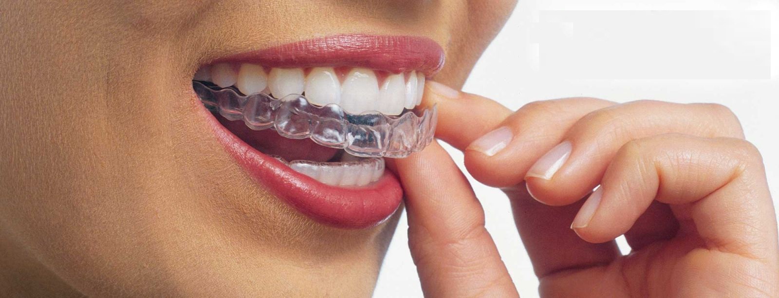 Top 5 Invisalign Secrets from Breslau Providers