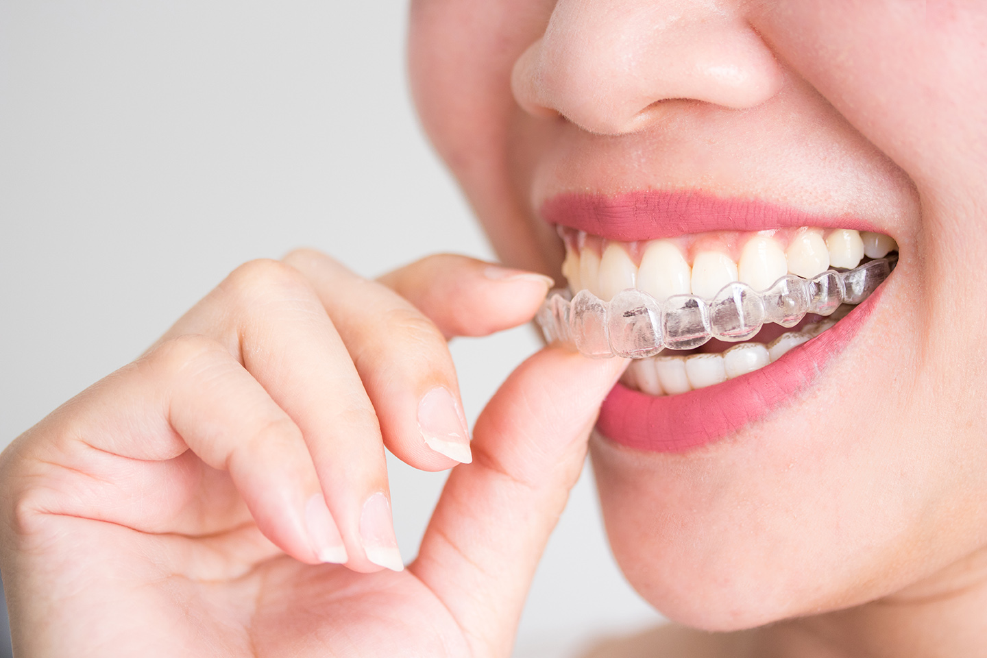Invisalign provider Breslau