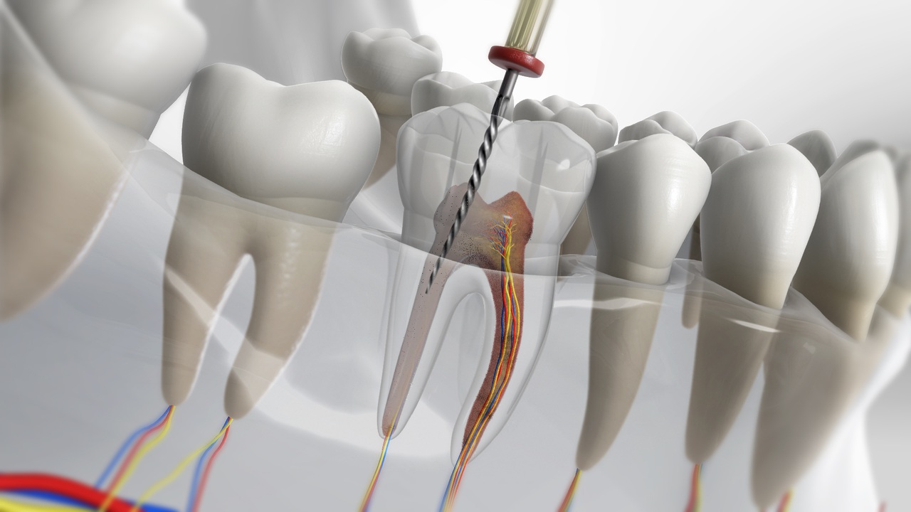 root-canal-in-kitchener-waterloo