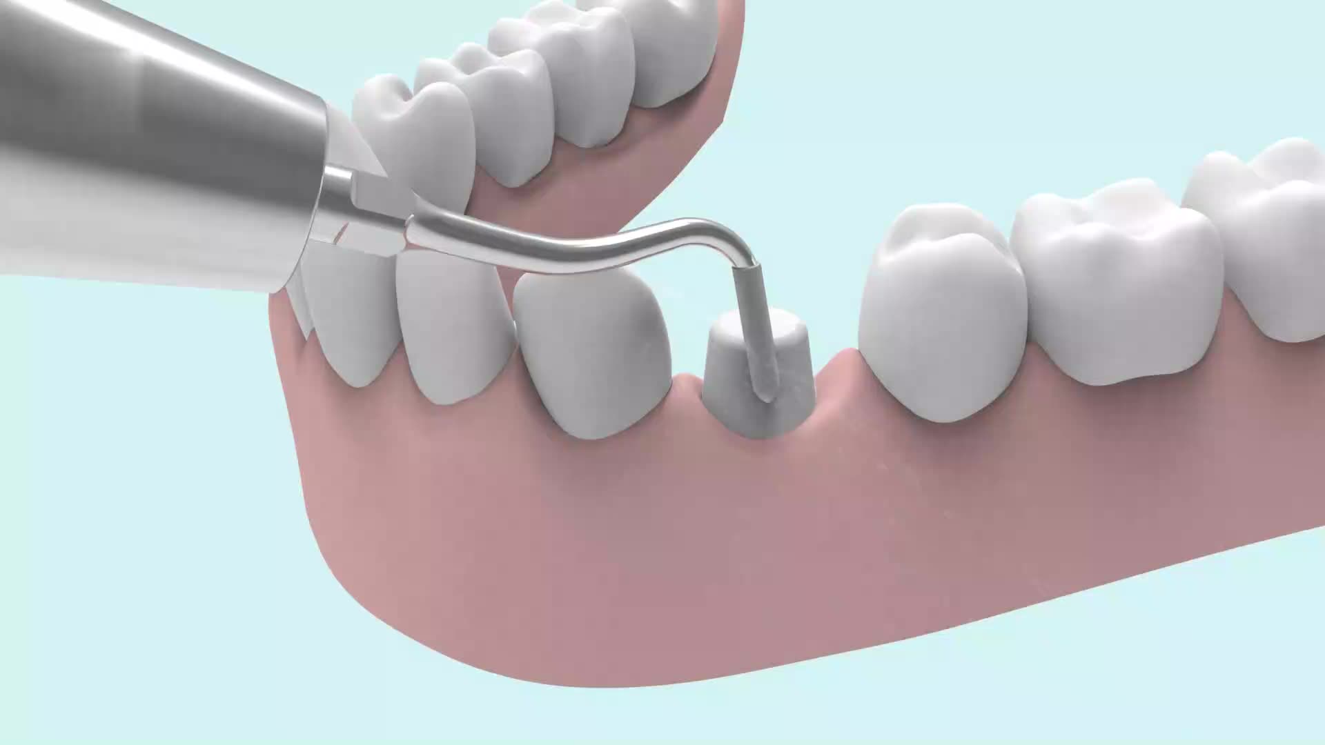 root-canal-in-kitchener-waterloo