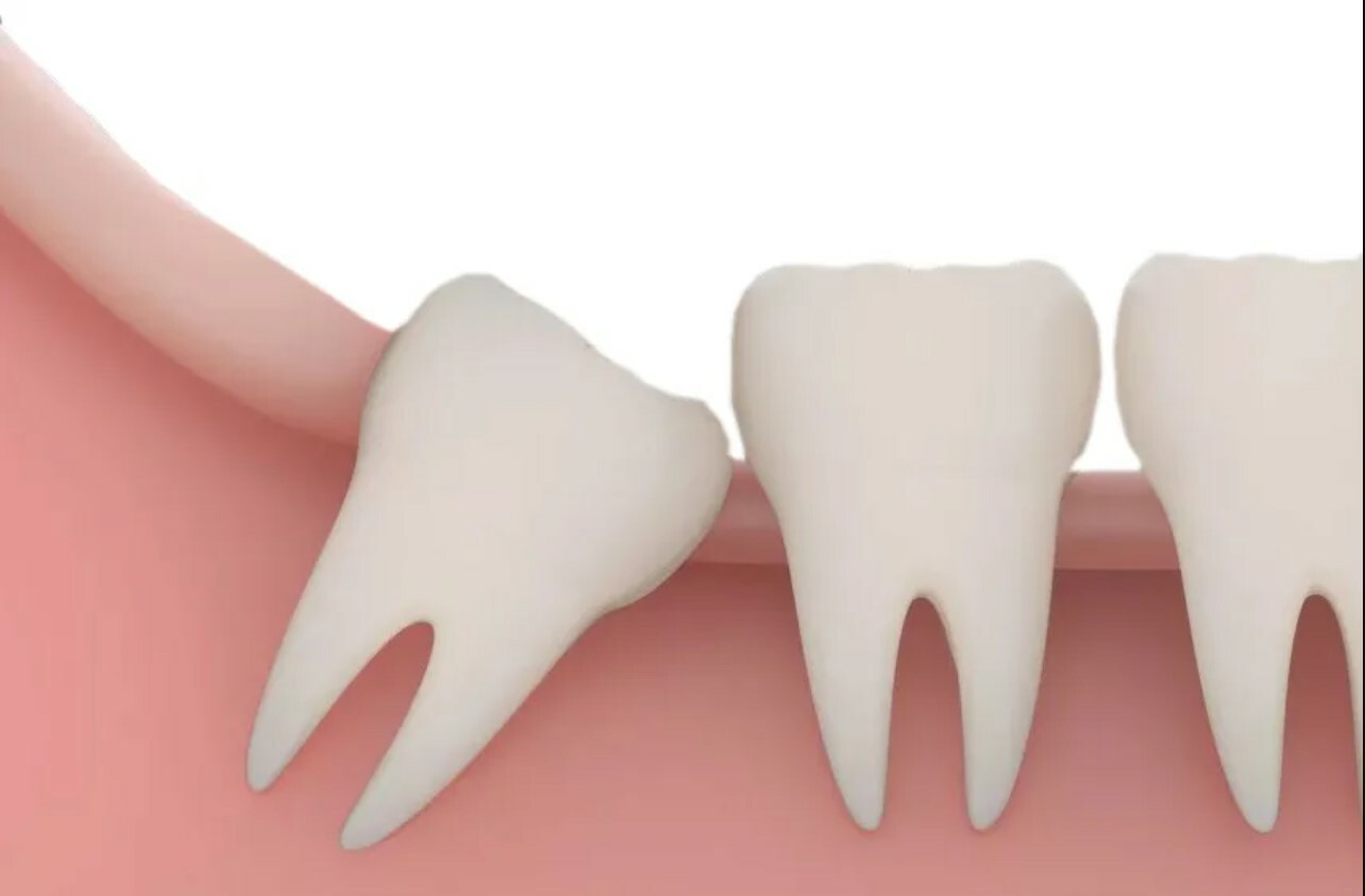 Wisdom Teeth Removal Kitchener: Local Anesthesia Vs. Sedation